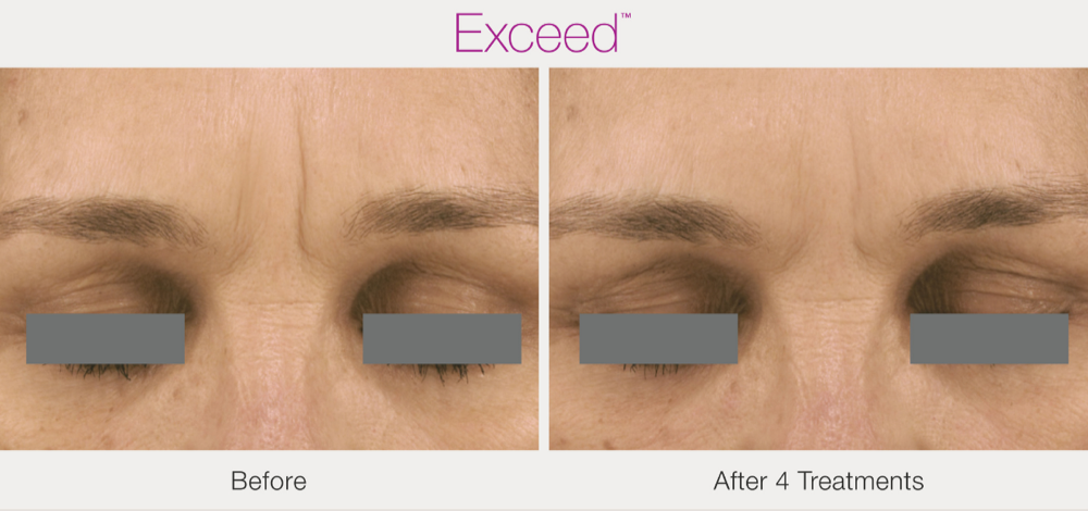 Skin microneedling before and after result